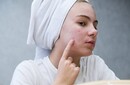 Acne na adolescência: SBP lança documento atualizado com foco no tratamento e na saúde mental 