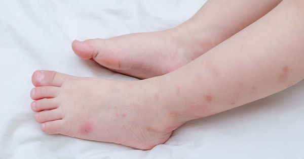Alergia A Picadas De Insetos O Pesadelo Do Verao Sbp