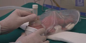 Reanimação do Prematuro na Sala de Parto